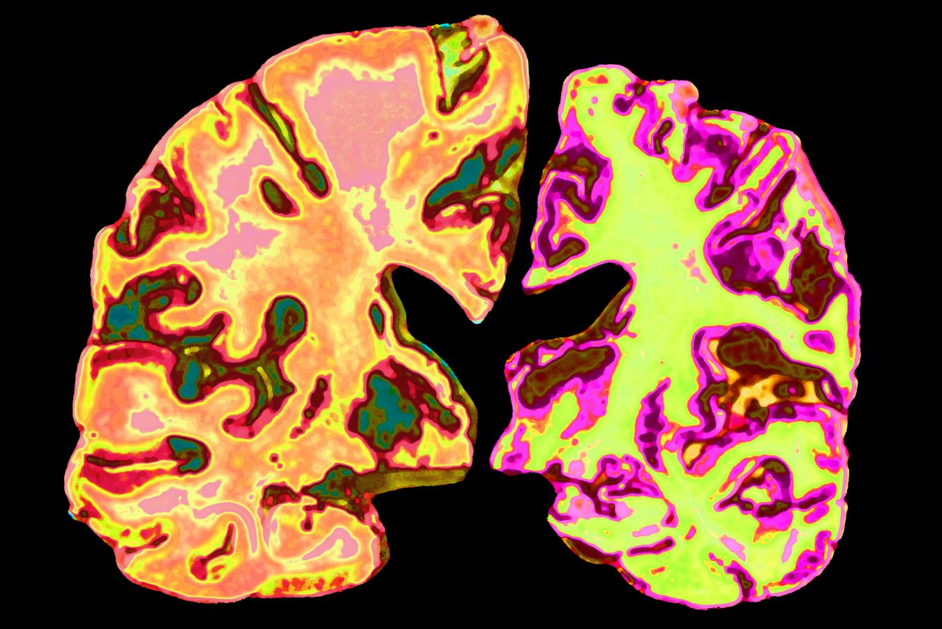 Human Trial to Test Lithium Orotate as Alzheimer's Prevention Set to Begin