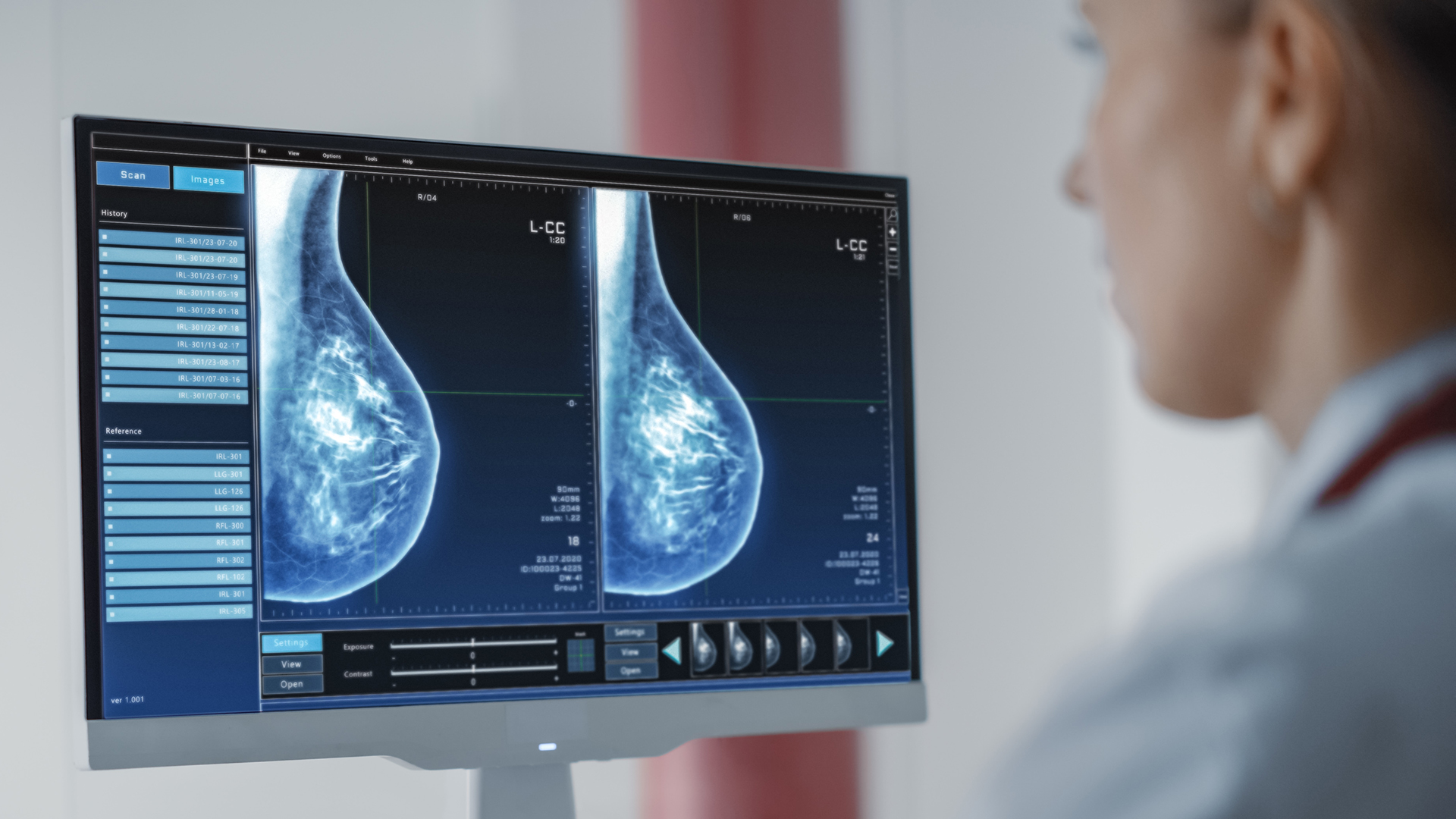 Nvidia-Backed AI Startups Push Breast Cancer Screening With Wearable Ultrasound and Risk Software