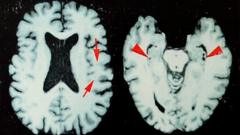Study: 1 in 4 Former NFL Players Who Died 2016-2021 Showed Brain Disease